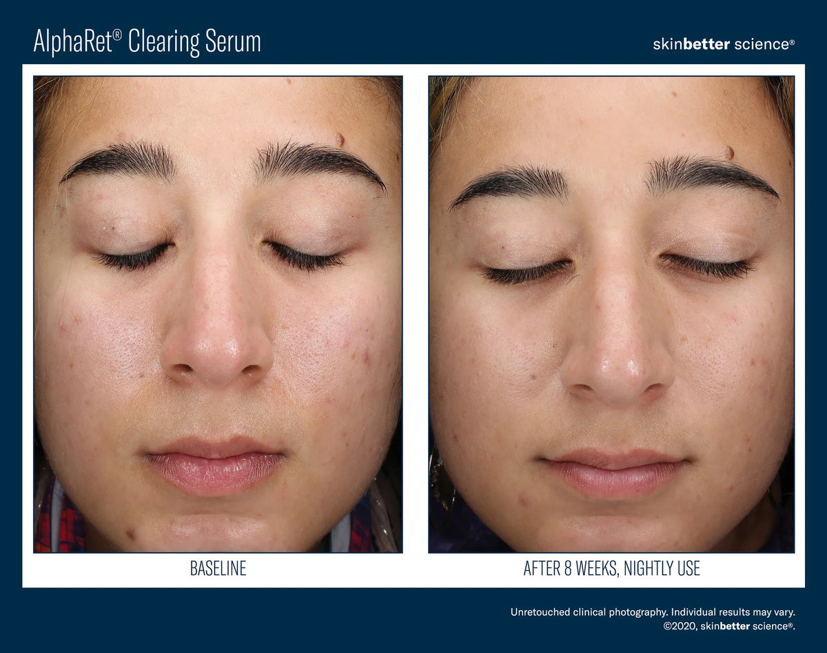 AlphaRet Clearing Serum 30ml