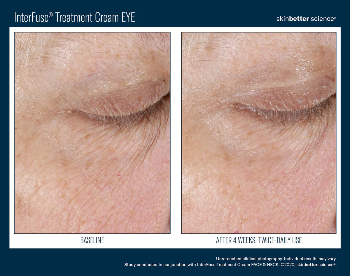 InterFuse Treatment Cream Eye 15ml